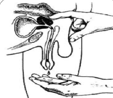 Massieren Sie die Prostata -Drüse, um Sekrete zu erhalten