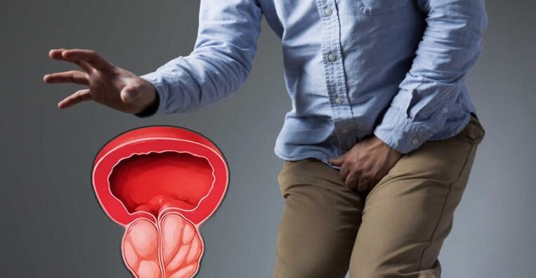 Prostatitisprävention und Prostata -Adenom